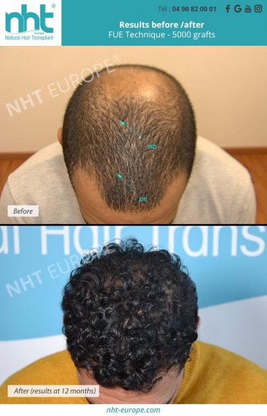 hairtransplant on curly hair 5000 grafts result at 1 year