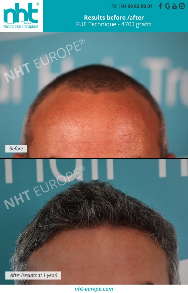 hair transplant on grey hair results before after fue technique 4700 grafts