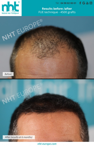 frontline-hairgrafting-4500-grafts-before-after-results-at-6-months