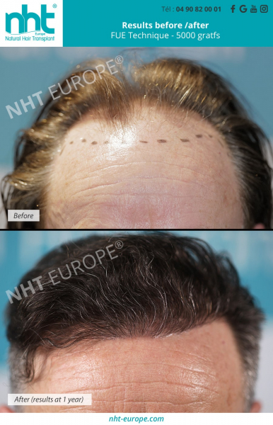 before-after-result-hair-transplant-5000-grafts-in-france-baldness-solution-hairloss-hair-implant