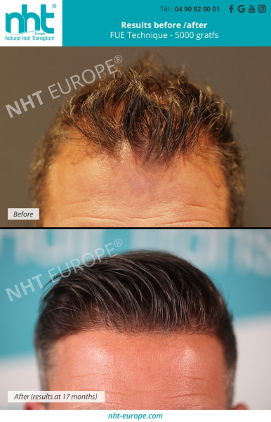 before-after-result-hair-transplant-5000-grafts-in-france-baldness-solution-hairloss-hair-implant