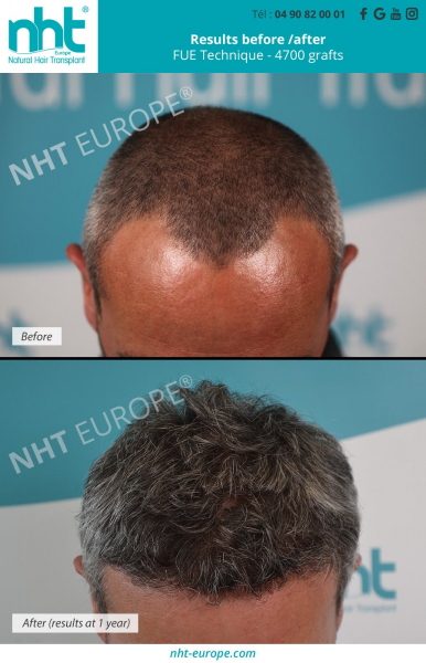 hair transplant on grey hair before after results fue technique 4700 grafts