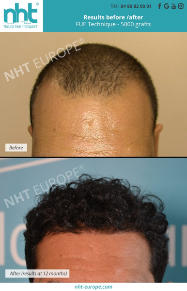 hairline hairtransplant nht europe before after results