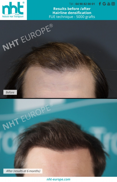 hair-transplant-results-before-after-at-6-months-fue-technique-5000-grafts-alopecia-bald-men-man-hair-line-densification-baldness-solution-thick-hair-forhead-top-pf-the-head-growth-hair