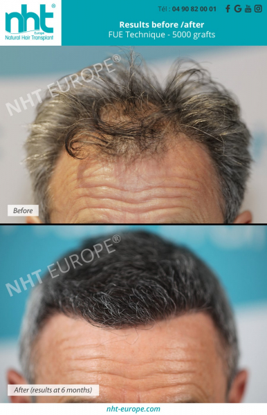 hair-transplant-result-before-after-fue-dhi-technique-5000-grafts-6-months-frontal-area-hairgrowth-baldness-solution-surgery-best-clinic-france-europe
