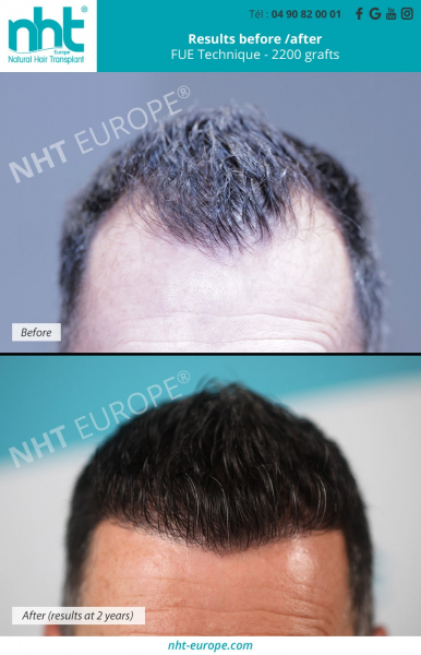 hair-transplantation-before-after-result-at-2-years-fue-dhi-technique-2200-grafts-frontal-area-baldness-and-hairloss-solution-best-clinic-france