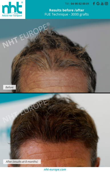 before-after-hair-transplant-results-before-after-3000-grafts-8-months-fue-dhi-technique-frontal-area-clinic-france