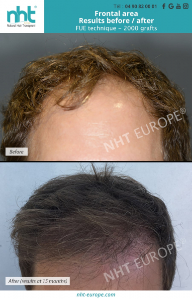 hair-transplant-of-2000-grafts-before-after-results-at-15-months
