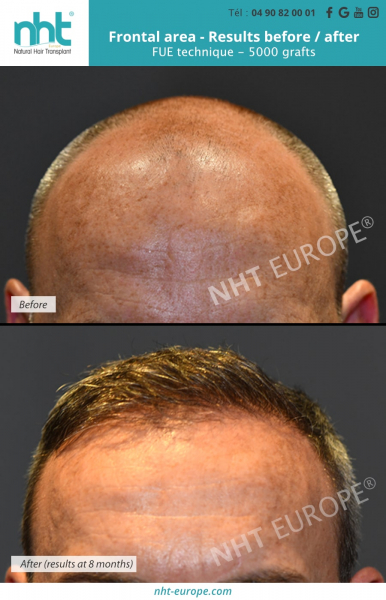 8-months-post-operative-frontal-area-hair-transplant