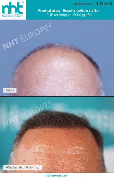 frontline-hairgrafting-6000-grafts-before-after-results-at-8-months