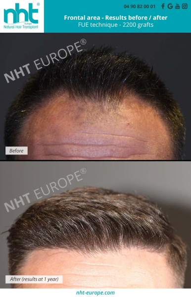 hair-transplant-2200-grafts-fue-technique-before-after-results-at-1-year