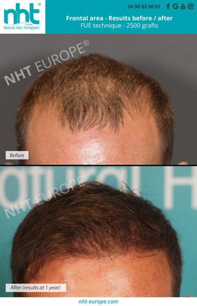 hair-transplant-frontal-area-fue-technique-2500-grafts