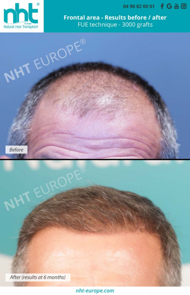 hair-transplantation-results-after-6-months-3000-grafts