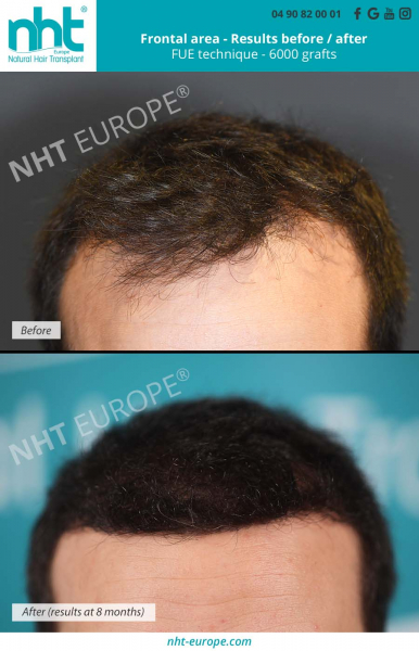 hair-transplantation-results-at-8-months-before-after-6000-grafts-frontline-area