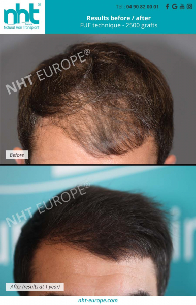 hairtransplant-fue-results-before-after-3000-grafts-hair-loss-solution