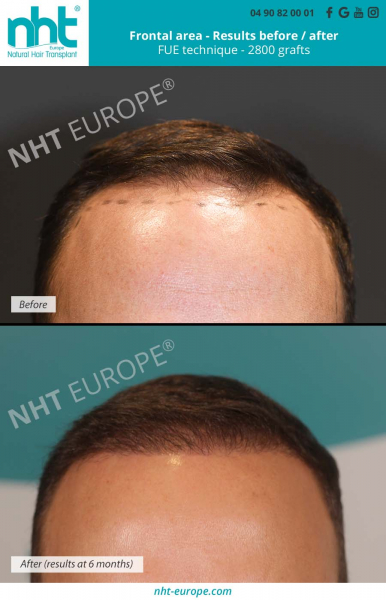 results-before-after-hair-transplant-2800-grafts-at-6-months