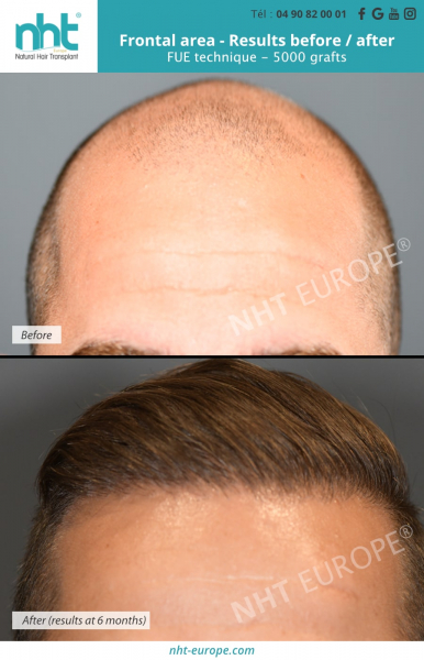 hair-transplantation-result-after-6-monts-on-the-frontal-area