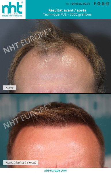 greffe-de-cheveux-implant-capillaire-methode-fue-resultats-avant-apres-3000-greffons-ligne-frontale
