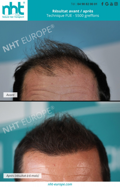 greffe-de-cheveux-implant-capilaire-france-resultat-avant-apres-à-6-mois-5500-greffons-ligne-frontale-redensification-cheveux-brun-golfes-fronto-temporaux-nht-clinique-avignon