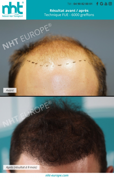 greffe-de-cheveux-implant-capillaire-chirurgie-esthetique-resultat-avant-apres-a-9-mois-par-technique-fue-6000-greffons-homme-cheveux-bruns-noire-zone-frontale-fronto-temporale-clinique-centre-nht-sud-de-la-france-avignon-marseille-nimes-montpellier-lyon-