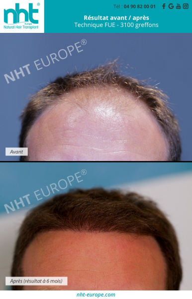 resultat greffe de cheveux 3100 greffons avant apres 6 mois zone frontale fronto temporale front golfes redensifier perte chute de cheveux calvitie alopecie solution technique dhi fue france traitement minoxidil finasteride clinique nht