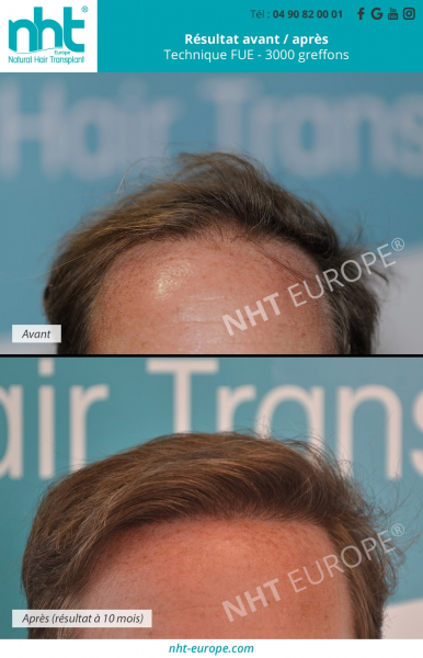 resultat-greffe-de-cheveux-avant-apres-3000-greffons-technique-dhi-fue-sur-la-ligne-frontale-10-mois-post-operatoire-repousse-des-cheveux