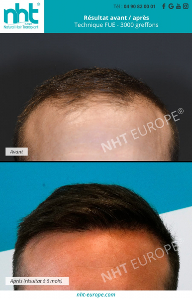 resultat-avant-apres-3000-greffons-technique-fue-avec-rasage-à-6-mois-clinique-greffe-de-cheveux-restoration-capillaire-nht-france-avignon-lyon-nimes-marseille-nice-cannes-toulon-toulouse