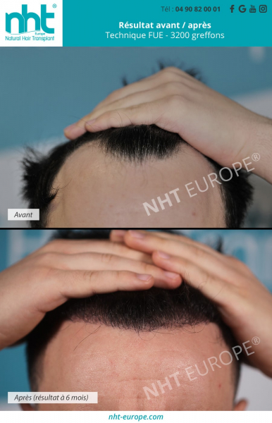 greffe-de-cheveux-ligne-frontale-golfes-fronto-temporaux-resultat-avant-apres-3200-greffons-technique-fue-a-6-mois-homme-calvitie-solution-perte-de-cheveux-alopécie-androgenetique-cheveux-qui-tombent
