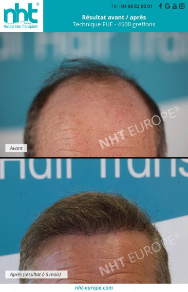 implant-capillaire-4500-greffons-technique-fue-folicules-pileux-dhi-avant-apres-resultat-a-6-mois-post-operatoire-ligne-frontale-recul-du-front-meilleure-clinique-greffe-de-cheveux-en-france-lyon-marseille-montpellier-nice-cannes-monaco