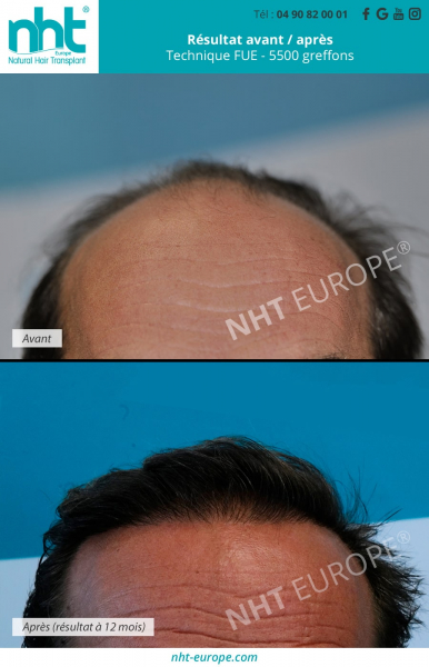 greffe de cheveux de 5500 greffons mega session avec la technique fue dhi resultat photos avant apres 1 an ligne fronto temporale clinique france lyon avignon paris lille marseille montpellier aix en provence