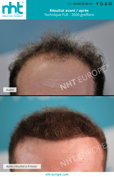 greffe de cheveux implant capillaire 3500 greffons technique fue dhi zone frontale cheveux chatains resultat avant apres 9 mois clinique nht avignon lyon paris aix en provence nice marseille