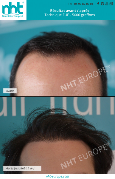 greffe de cheveux implant capillaire 5000 greffons technique fue dhi ligne frontale cheveux brun resultat avant apres 1 an clinique nht avignon lyon paris aix en provence nice