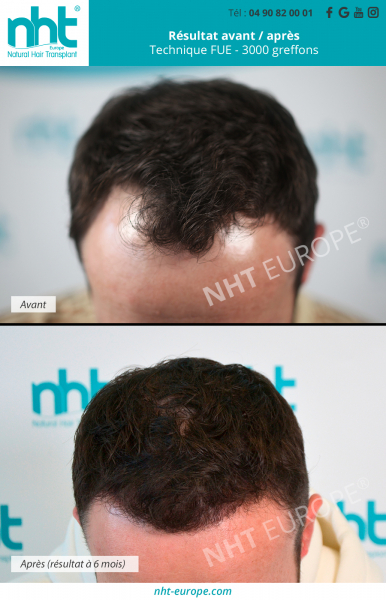 greffe capillaire 3000 greffons technique fue dhi resultat avant apres 6 mois repousse des cheveux calvitie solution alopecie golfes temporaux clinique nht france avignon lyon paris marseille aix en provence nice