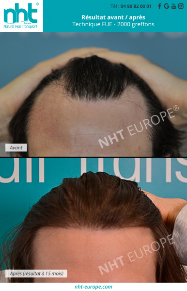 greffe de cheveux implant capillaire 2000 greffons technique fue dhi resultat avant apres 15 mois repousse des cheveux densification ligne frontale clinique nht specialisée avignon france lyon paris
