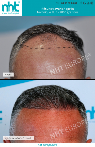 greffe-de-cheveux-implants-capillaires-dhi-fue-2800-greffons-resultat-avant-apres-6-mois-repousse-des-cheveux-calvitie-chute-alopécie-solution-clinique-nht-avignon-lyon-paris-nice-monaco