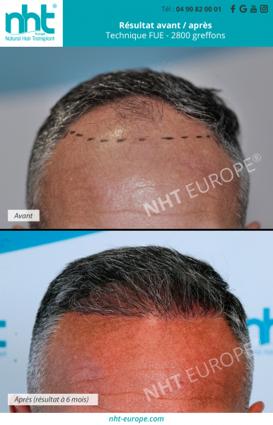 greffe de cheveux implants capillaires dhi fue 2800 greffon resultat avant apres 6 mois repousse des cheveux calvitie chute alopécie solution clinique nht avignon lyon paris nice monaco