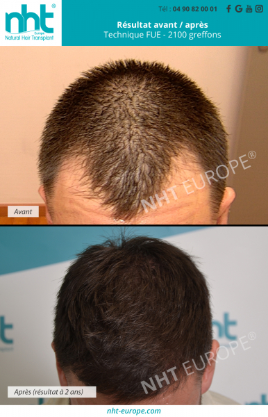 greffe-capillaire-2100-greffons-resultat-avant-apres-2-ans-technique-fue-dhi-chute-perte-des-cheveux-calvitie-solution-clinique-du-cheveux-avignon-paris-lyon