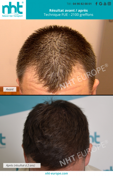 greffe capillaire 2100 greffons resultat avant apres 2 ans technique fue dhi chute perte des cheveux calvitie solution clinique du cheveux avignon paris lyon