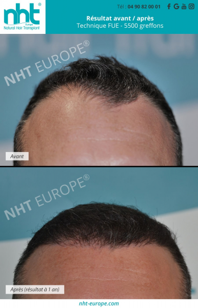 implants-capillaires-5500-greffons-greffe-de-cheveux-resultat-avant-apres-1-an-repousse-cheveux-calvitie-alopecie-solution-clinique-france-nht-avignon-marseille-montpellier-nice-nimes-lyon-paris