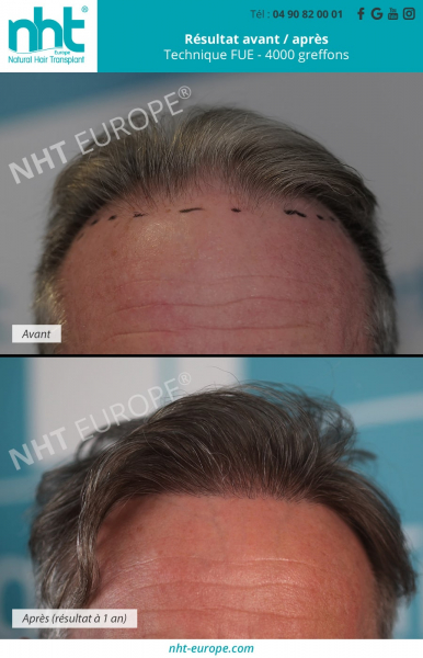 greffe de cheveux 4000 greffons ligne frontale resultat avant apres golfes fronto temporaux arreter la chute des cheveux lutter contre la calvitie solution homme centre france avignon lyon marseille montpellier grenoble paris
