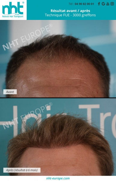 transplantation-capillaire-avant-du-crane-ligne-frontale-golfes-temporaux-greffe-de-cheveux-de-3000-greffons-technique-methode-dhi-fue-sans-cicatrice-resultat-avant-apres-6-mois-pousse-des-cheveux-calvitie-solution-alopecie-homme-clinique-en-france-nht-av
