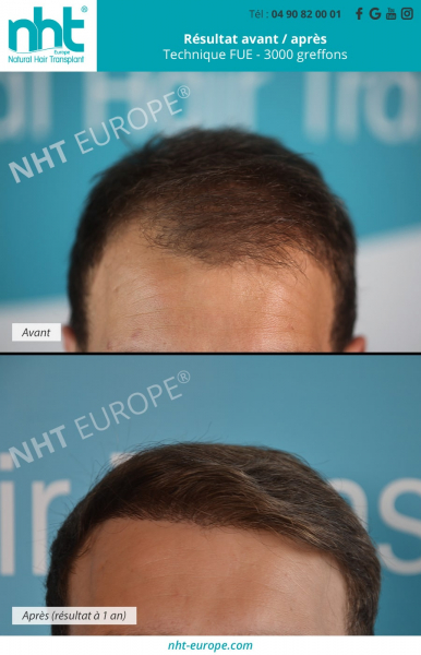 greffe de cheveux resultat 1 an alopecie calvitie chute de cheveux solution chirurgicale