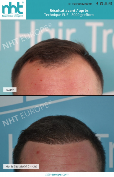 greffe de cheveux ligne frontale golfes temporaux nht europe