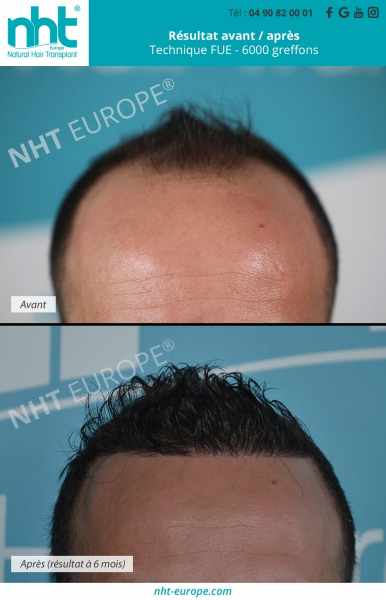 maxi greffe de cheveux 6000 greffons technique fue dhi resultat avant apres 6 mois ligne frontale golfes temporaux clinique nht france