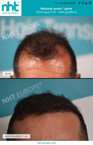 greffe de cheveux technique fue 4000 greffons resultat 1 an avant apres