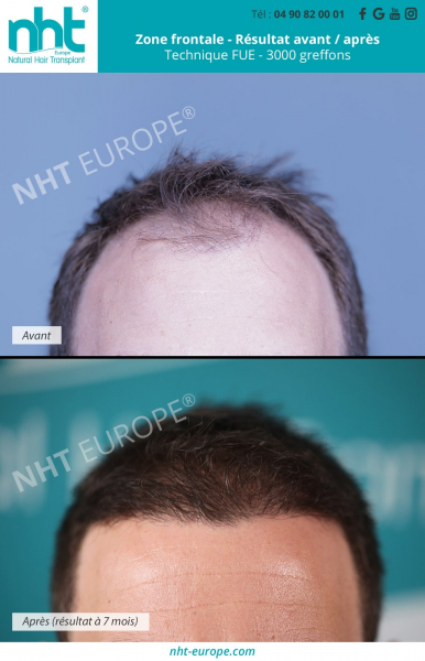 greffe-de-cheveux-de-3000-greffons-ligne-frontale-densification-repousse-des-cheveux-resultats-avant-apres-7-mois