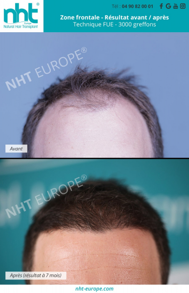 greffe de cheveux de 3000 greffons ligne frontale densification repousse des cheveux resultats avant apres 7 mois