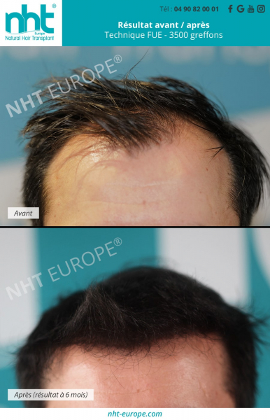 greffe-de-cheveux-implant-capillaire-chirurgie-esthetique-resultat-avant-apres-a-6-mois-par-technique-fue-3500-greffons-homme-cheveux-bruns-noire-zone-frontale-fronto-temporale-clinique-centre-nht-sud-de-la-france-avignon-marseille-nimes-montpellier-lyon-