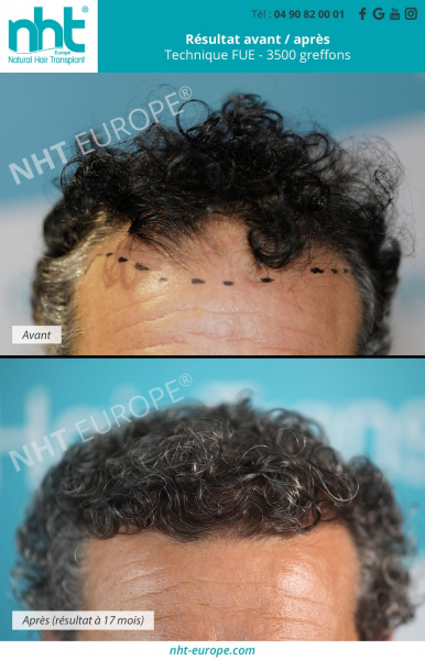 greffe capillaire ligne frontale avant de la tete sur cheveux bouclés resultat avant apres 3500 greffons a 17 mois technique fue dhi calvtie solution perte chute de cheveux homme clinique centre nht sud de la france avignon montpellier nimes marseille