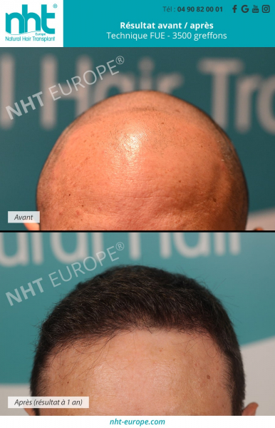 greffe-de-cheveux-resultat-avant-apres-3500-greffons-fue-dhi-sommet-du-crane-clinique-nht-europe-avignon-